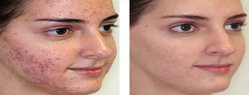 anti acne treatment in patna