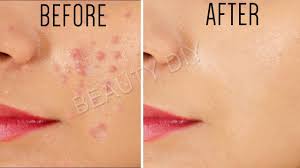 best pimple doctor in patna